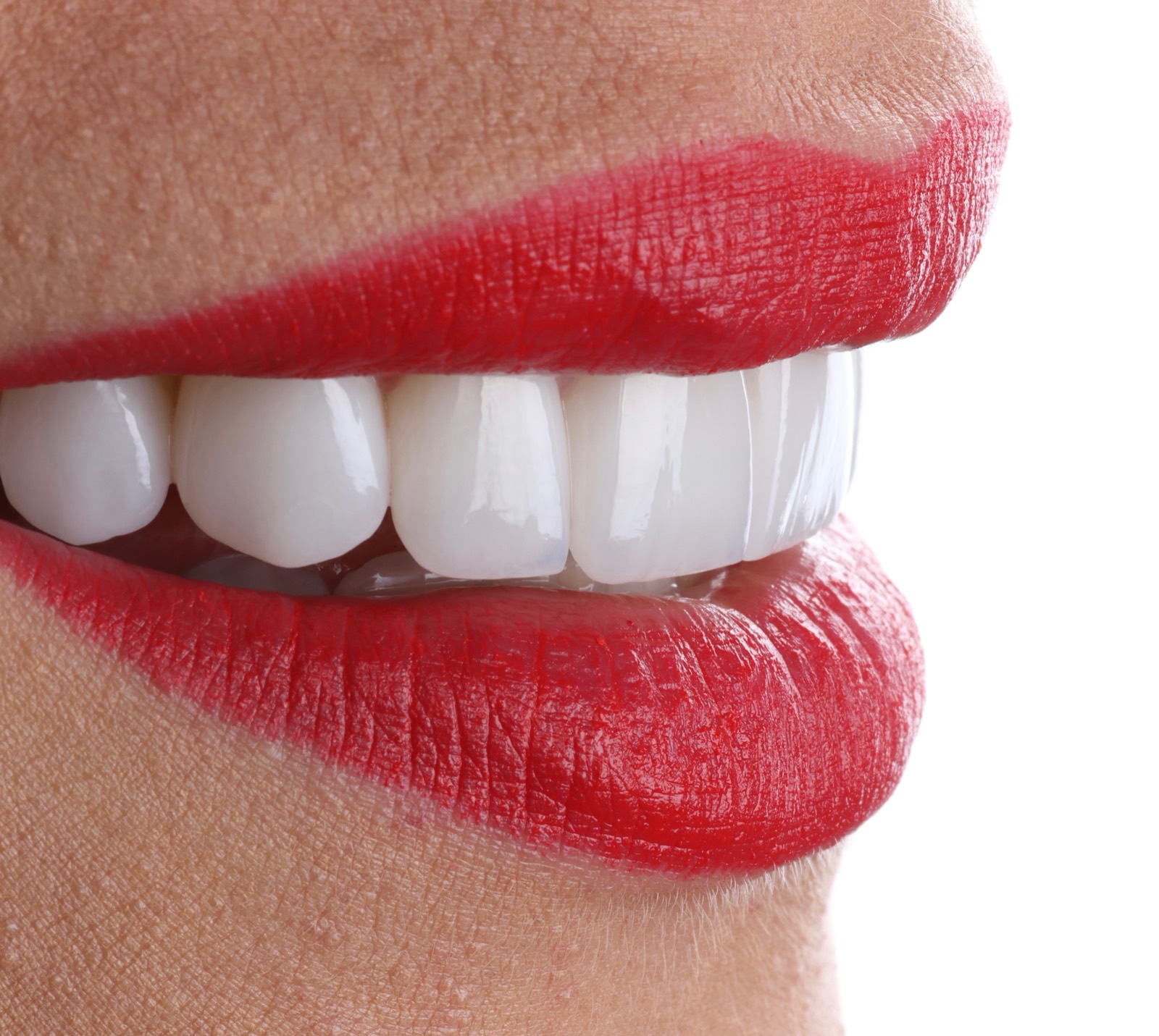 Porcelain Veneers at Helix Dental
