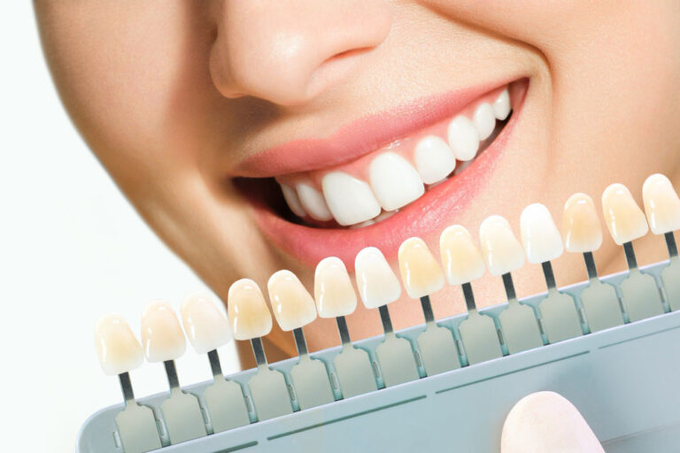 The Ultimate Guide To Dental Veneers A Smile Transformation In One Simple Procedure