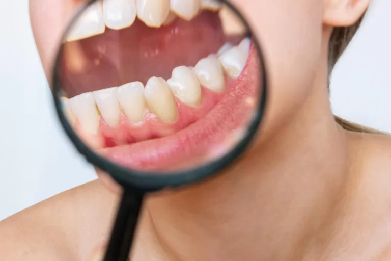 Is Tooth Sensitivity Linked To Enamel Erosion