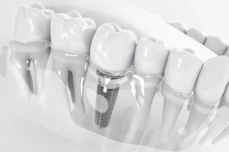 What To Expect In Dental Implant Technology In 2024